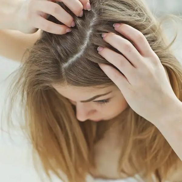 What is alopecia?