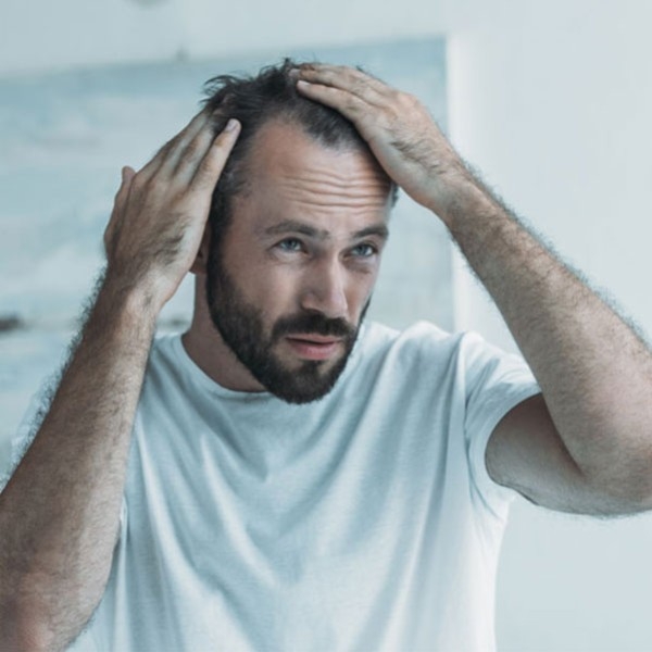 Alopecia: ¿qué es y cómo tratarla?